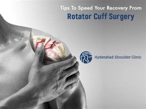 Tips To Speed Your Recovery From Rotator Cuff Surgery - shoulder clinic Hyderabad