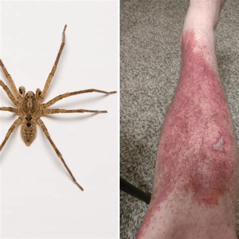 Brown Recluse Spider Bite Rash