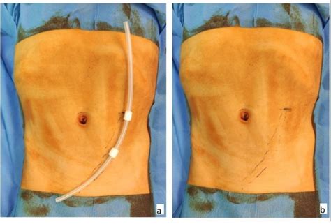 Figure 1 from Peritoneal Dialysis Catheter Placement in Children: Initial Experience with a “2+1 ...