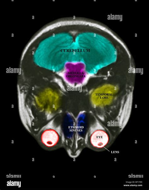 MRI scan of the brain, with the major structures labeled Stock Photo - Alamy