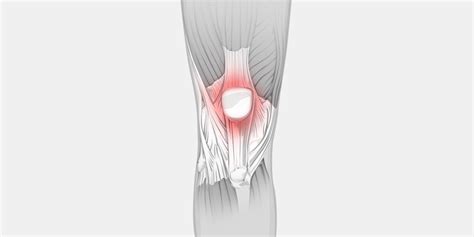 Femoral Pain Syndrome