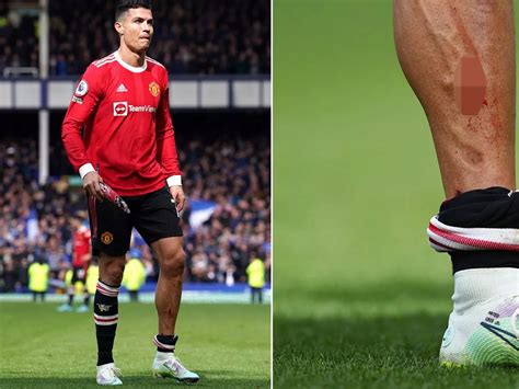 Cristiano Ronaldo Ugly Feet