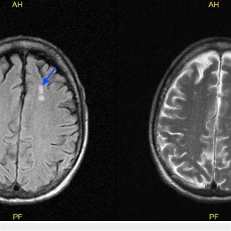 Brain Mri Showing Lesions