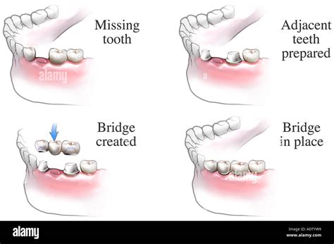 Dental Bridge Procedure