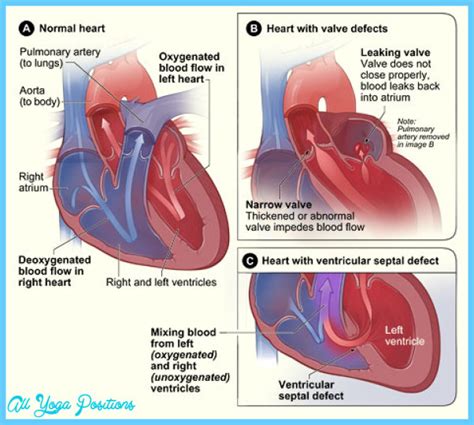 What’s a heart murmur, and is it dangerous? - AllYogaPositions.com