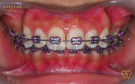 Braces Colors: Top Picks For 2023 - Stellar Dental