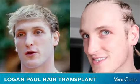 Logan Paul Hair Transplant: Did He Undergo a Hair Transplant?