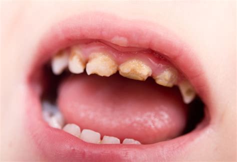 Tooth Decay in Children: Contagious Cavities & Prevention