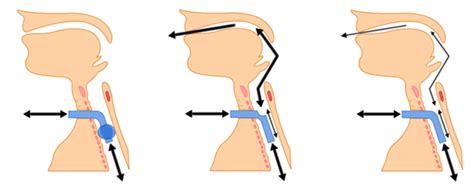 Fenestrated Tracheostomy Tube