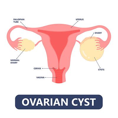 2024 Guide About Ovarian Cysts and Treatments| Vejthani