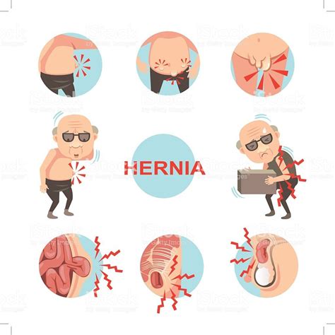 Scrotal Hernia Diagram