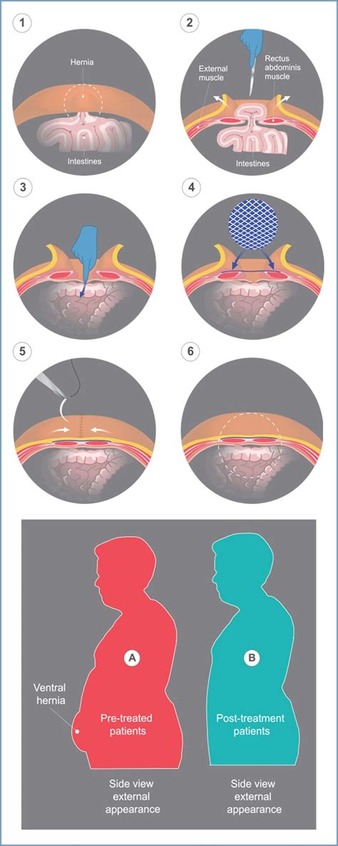 Incisional Hernia Repair – Yellowstone Surgery Center