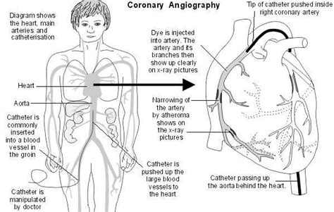 Coronary Angiography. Medical investigation into angina | Patient