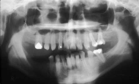 Hypodontia and Taurodontism. Orthopantomogram showing hypodontia with... | Download Scientific ...