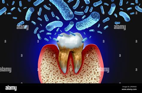 Bacterial tooth infection and teeth decay disease as an unhealthy molar with periodontitis due ...