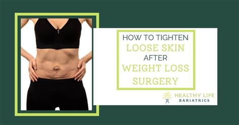 How to Tighten Loose Skin After Bariatric Surgery? Los Angeles