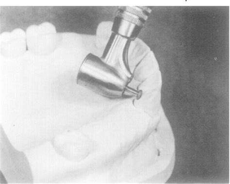 Figure 3 from Alternative cingulum rest seat. | Semantic Scholar