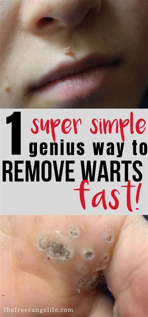 How To Remove Warts On Elbow - HOWTOREMVO