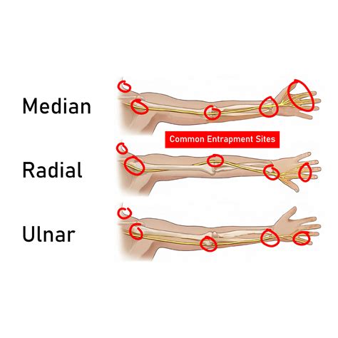 How To Fix Ulnar Nerve Entrapment | Causes & Symptoms | Gymless