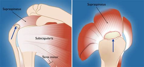 Repair of rotator cuff tendon | Iranian Surgery