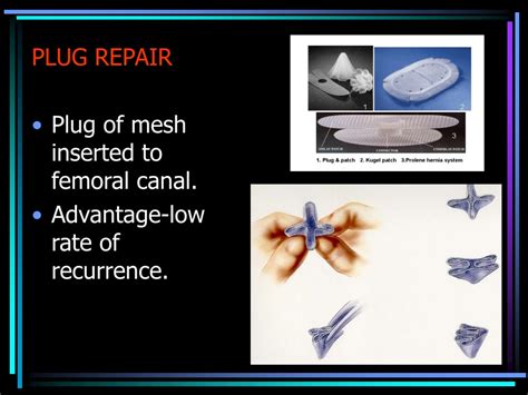 PPT - FEMORAL HERNIA & SLIDING HERNIA PowerPoint Presentation - ID:9423392