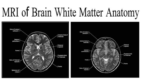 Mri Brain White Matter Abnormalities Mri Scan Images Mri Brain | sexiezpix Web Porn