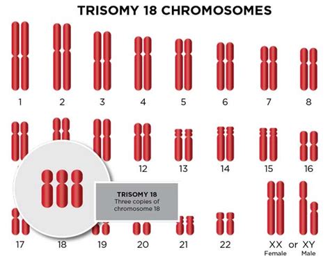 Trisomy 18 (Edwards Syndrome): Types & Diagnosis