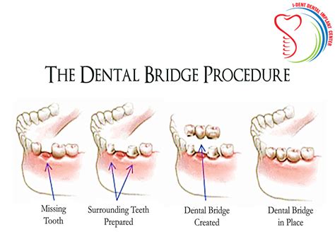 Dental Bridge Procedure