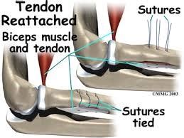 What is a Biceps Tendon Rupture and How is it Fixed?