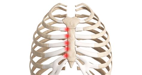 Costochondral Separation: Causes, Symptoms, Diagnosis, Treatment, & - Healthroid