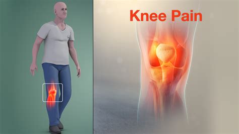 Knee Pain Caused By Damage In Knee Joint Shown Using Medical Animation