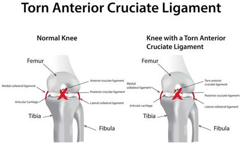 What is Anterior Cruciate Ligament (ACL) Injury? (Symptoms & Reasons)