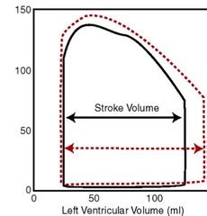 Increased EDV (inc. preload).