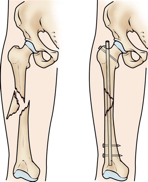 Closed Femur Fracture