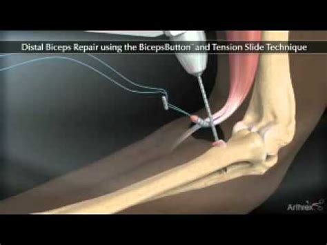 Distal Biceps Repair Animation - YouTube