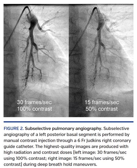 Optimal Technique for Performing Invasive Pulmonary Angiography for Chronic Thromboembolic ...