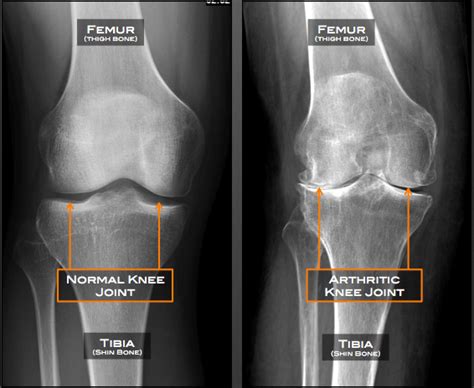 Knee Arthritis Austin, TX | Knee Osteoarthritis Austin, TX | Cedar Park