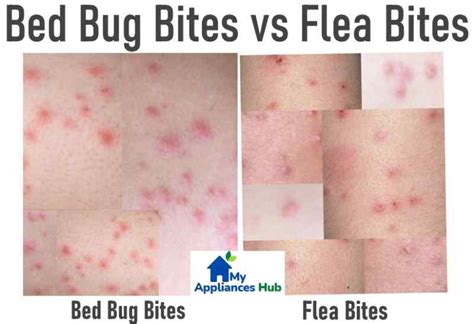 Sand Flea Bites Vs Bed Bug Bites – NBKomputer