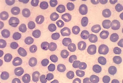 Babesiosis laboratory findings - wikidoc