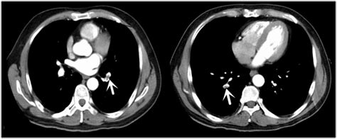 Computed tomographic pulmonary angiography images of a 58-year-old male... | Download Scientific ...