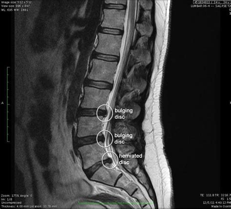 Lumbar Spine Mri Bulging Disc