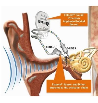 The Esteem Middle Ear Implant Liz Anderson Bone Conduction & Middle Ear Implants/Aids Hearing ...