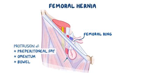 Female Femoral Hernia Images