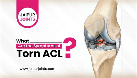 5 Signs and Symptoms of Torn ACL - Dr. Lalit Modi