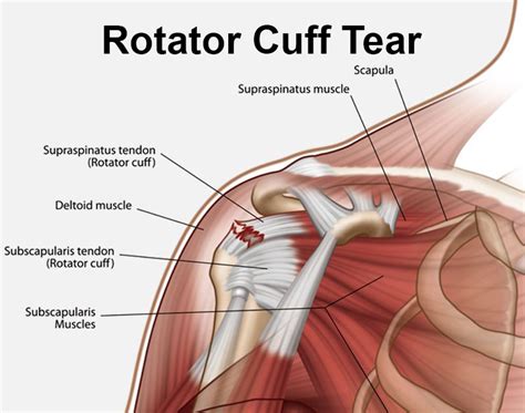 Rotator Cuff Tear - Gold Coast Hand + Upper Limb Clinic