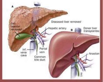 Pig heart transplant in human - Massive E-Journal Photography