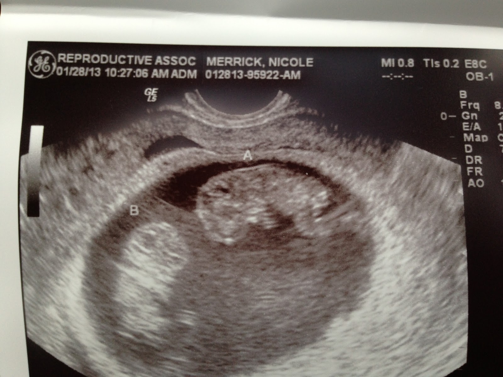 9 Week Ultrasound Identical Twins