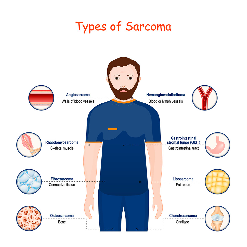 Cell and gene therapy for sarcomas | Alliance for Cancer Gene Therapy