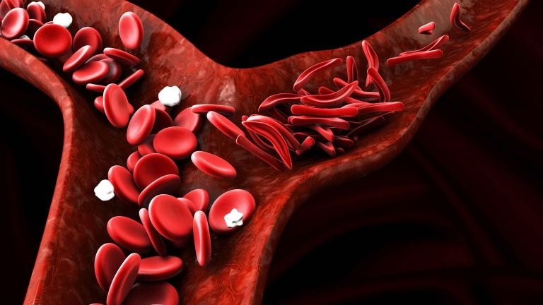 Sistema imune de pacientes com anemia falciforme melhora após transplante de células-tronco da medula