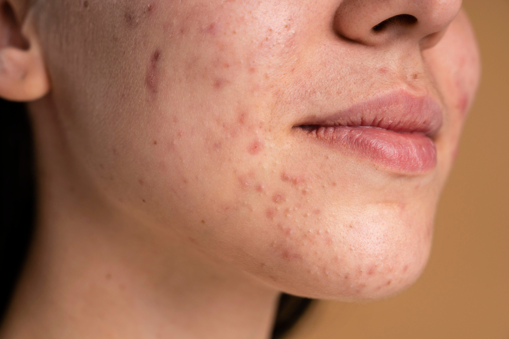 Grupo da UFSCar busca voluntários para projeto que testa eficácia de tratamento para acne